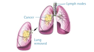 gejala kanker paru paru